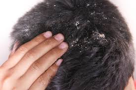 dandruff
